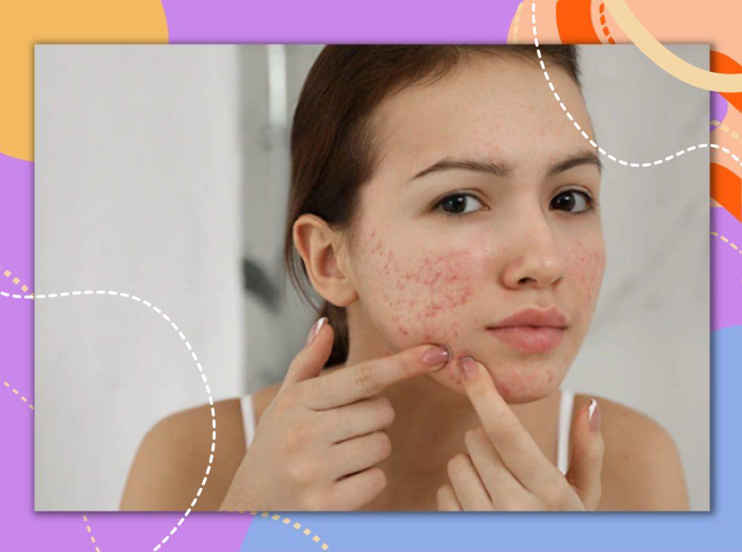 Stubborn Acne Can Pop Up Anytime So, Here’s A List Of The Best Acne Cream Treatments For You