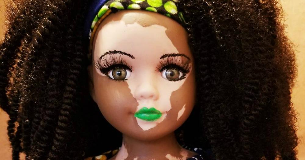 Here&#8217;s Why These Dolls Representing Vitiligo Are SO Important!