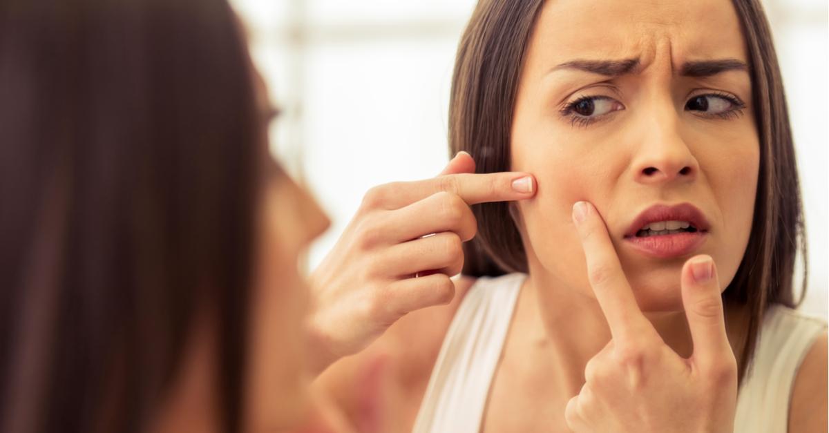 These Magical Home Remedies Are Great Fixes For Pesky Pimples