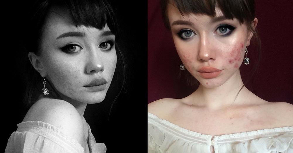 An Instagram Influencer&#8217;s Post For People Struggling With Acne Is Going Viral &amp; It&#8217;s Truly Inspiring