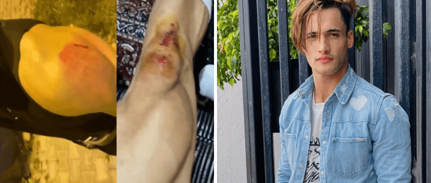 Asim Riaz Shares Shocking Ordeal After Being Assaulted, Fans Wish Him A Speedy Recovery