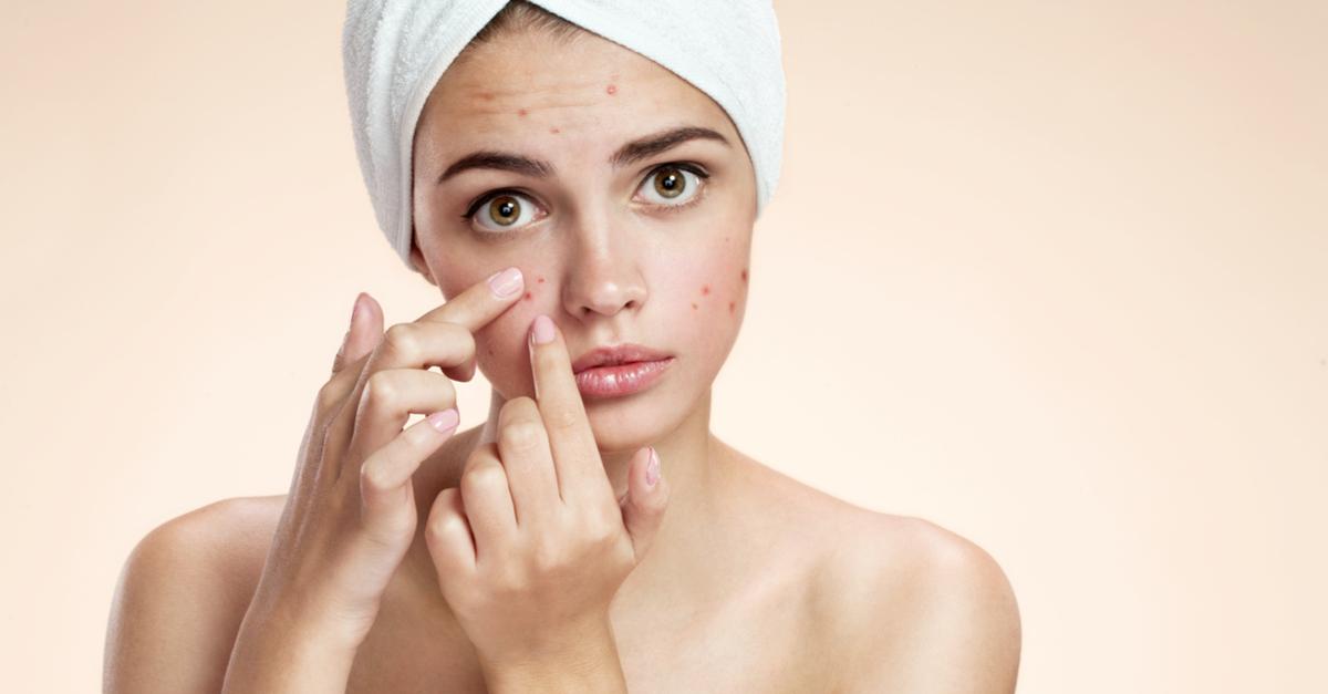 What If We Told You The Most Effective Pimple Remedy Costs NOTHING
