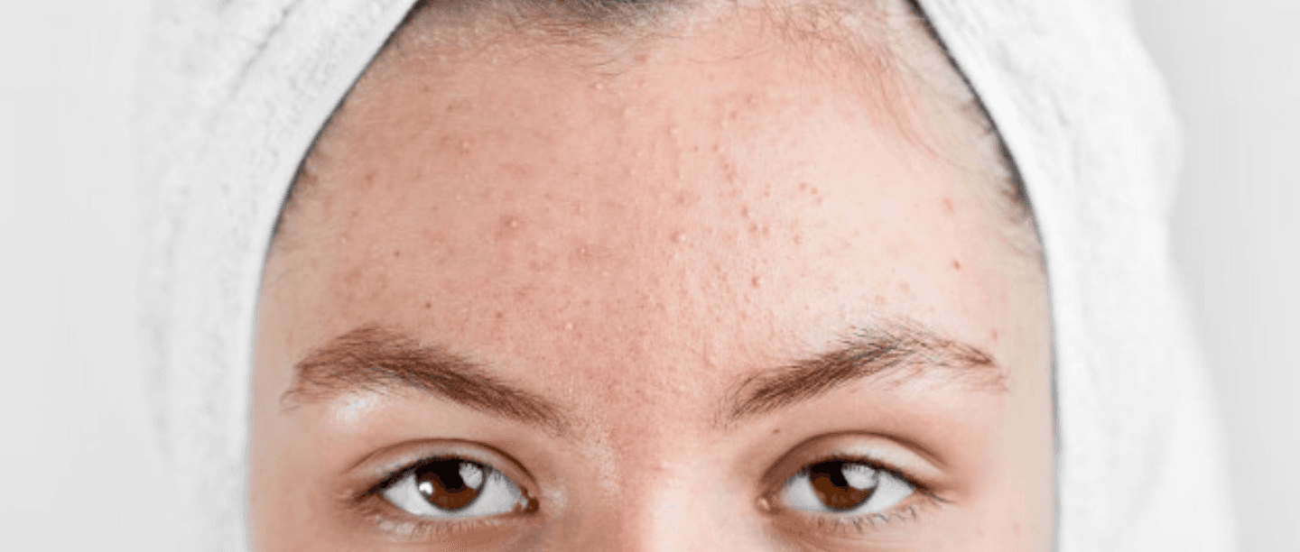 Breaking (Out) Bad: Why Those Pesky Pimples Are Having A Gala Time On Your Forehead