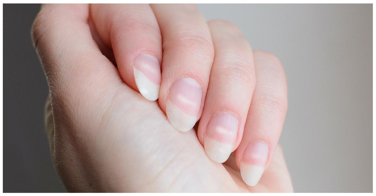 Here&#8217;s What Is Really Causing Those White Spots On Your Nails
