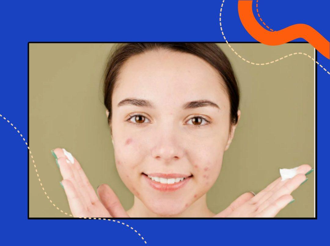 12 Acne Scar Removal Creams To Bid Adieu To Pesky Spots And Pigmentation