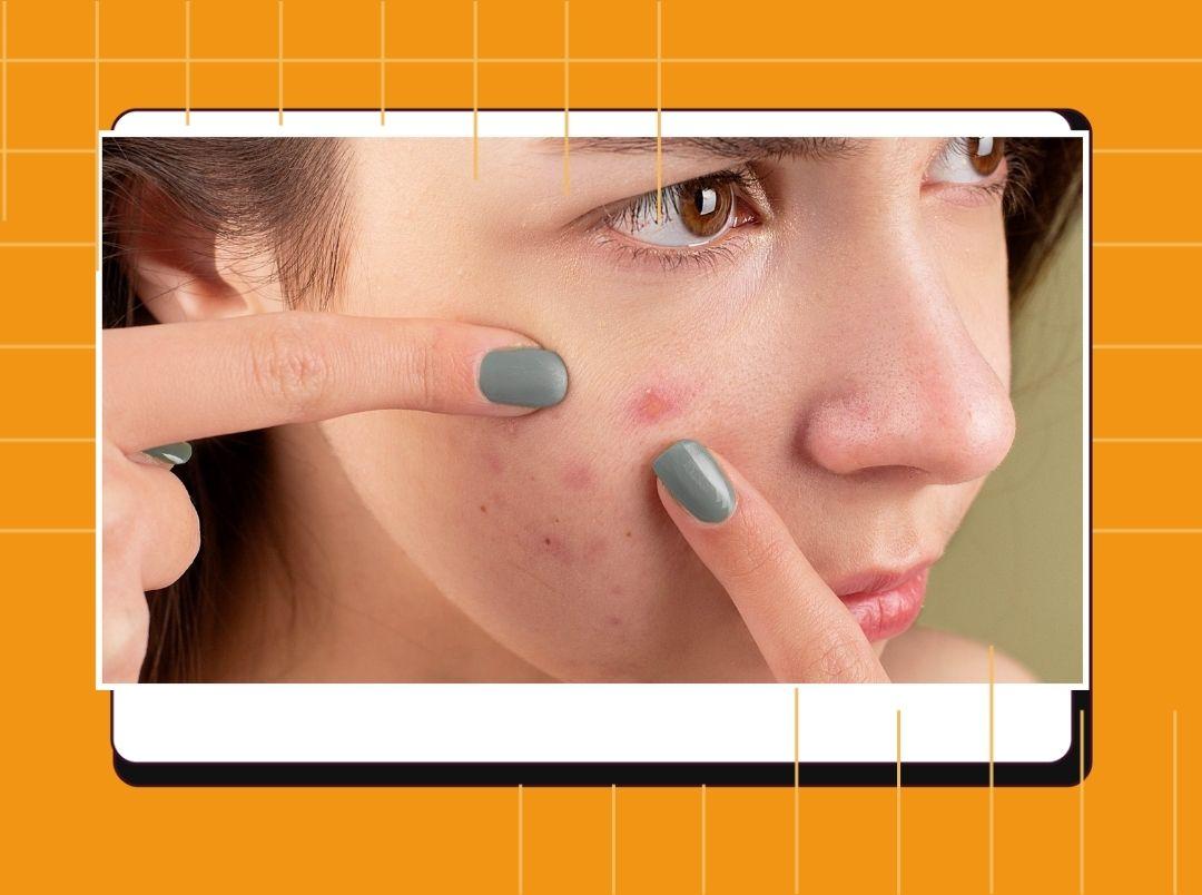 3 DIYs Using Tea Tree Oil That Will Soothe Your Acne-Prone Skin