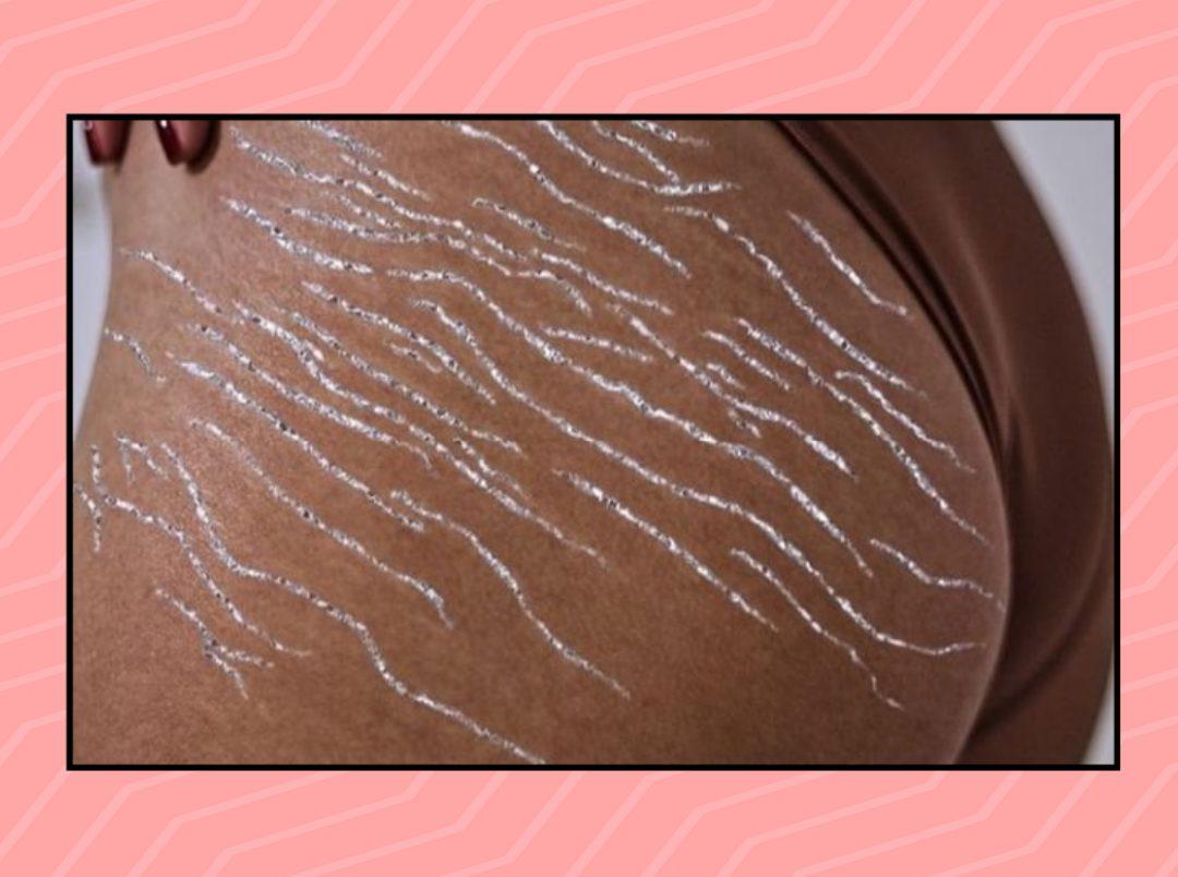 6 Natural Ways To Reduce The Appearance Of Stretch Marks