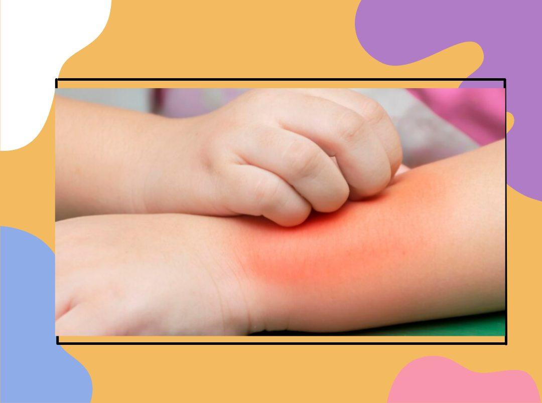 6 Effective Ways To Prevent Heat Rashes In Toddlers