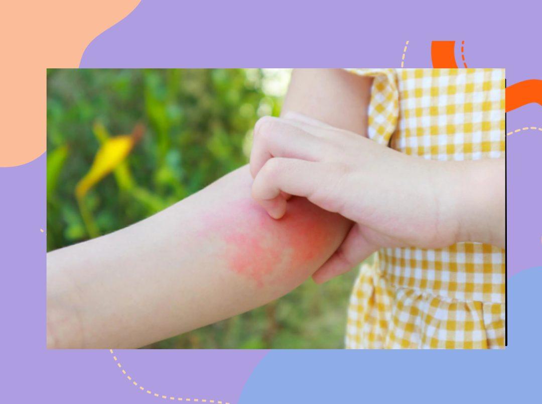 7 Effective Remedies To Treat Eczema In Kids