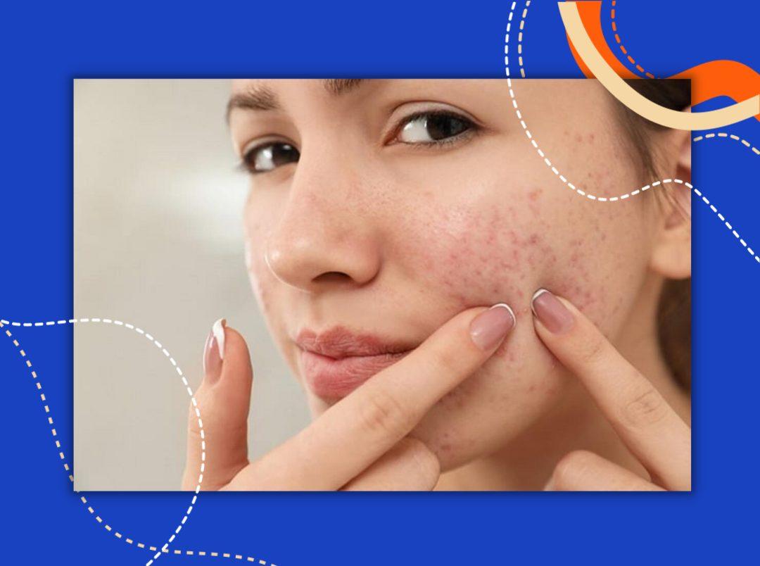 Shoot That Zit Down! Here&#8217;s How To Get Rid Of Painful Red Pimples Overnight