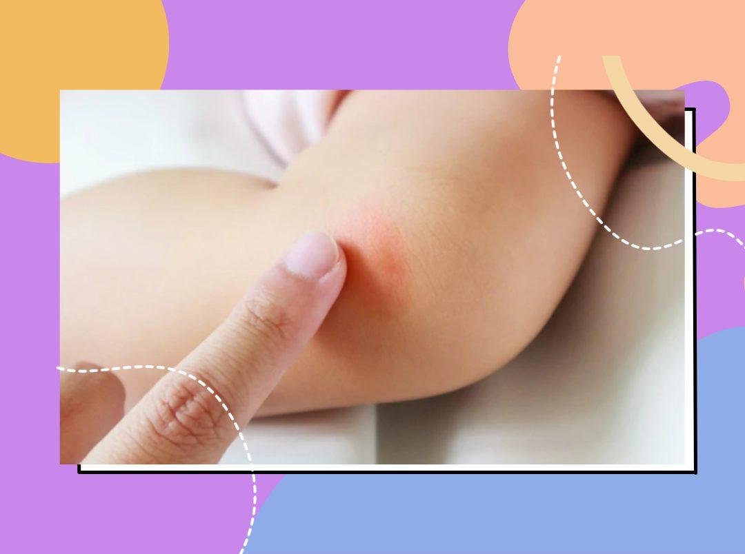 How To Treat Mosquito Bite Marks On Babies