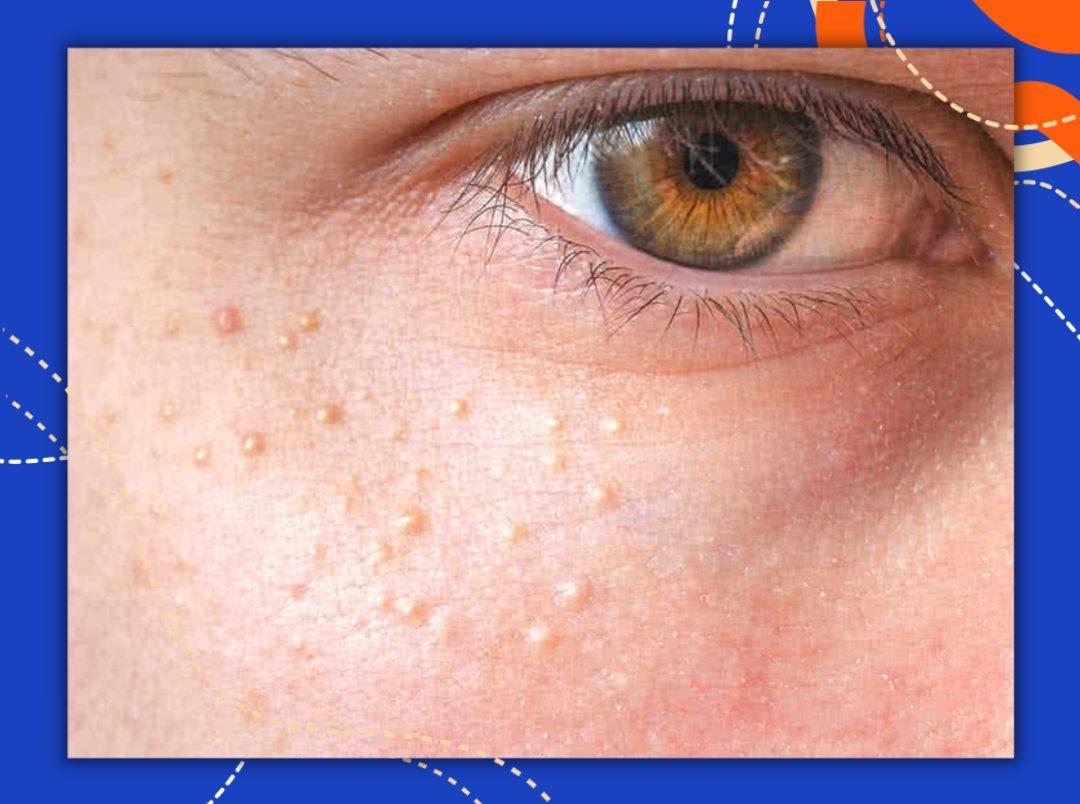 Do You Have Milia On Your Skin? Here Is All The Information You Need On Those Tiny White Bumps